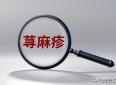 荨麻疹反复发作？荨麻疹能不能断根，先做好这3件小事